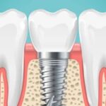 Dental Implants Stockton CA